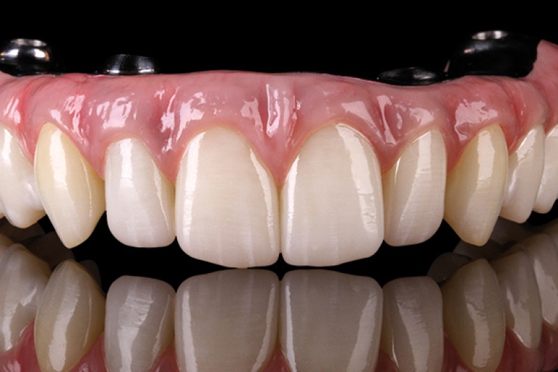 Зубы после Имплантации All-on-4